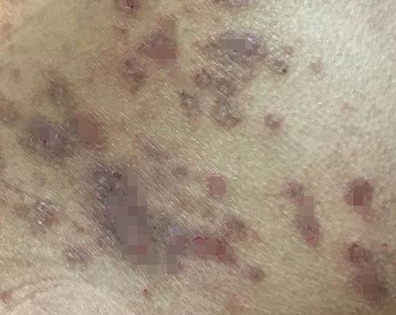 皮肤起红斑越挠越痒，揭秘背后的病因与应对策略