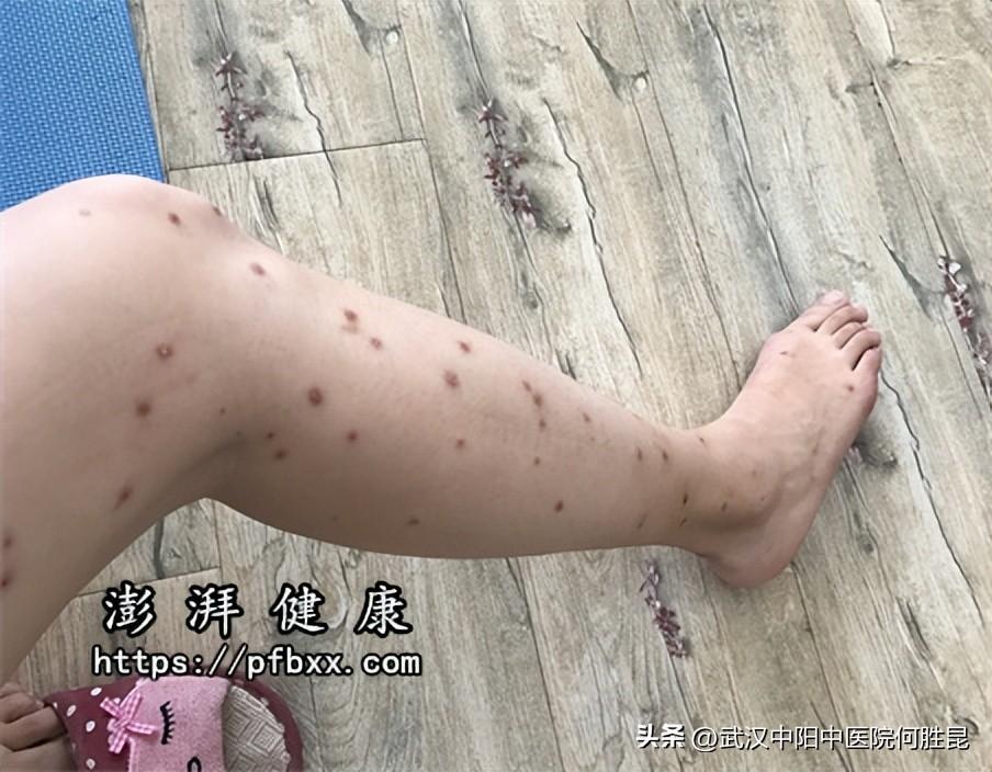 皮肤痒的烦恼与应对策略，科学止痒，回归舒适