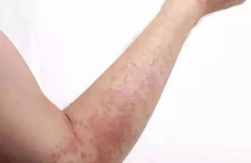 血液皮肤病，识别与理解其症状的重要性