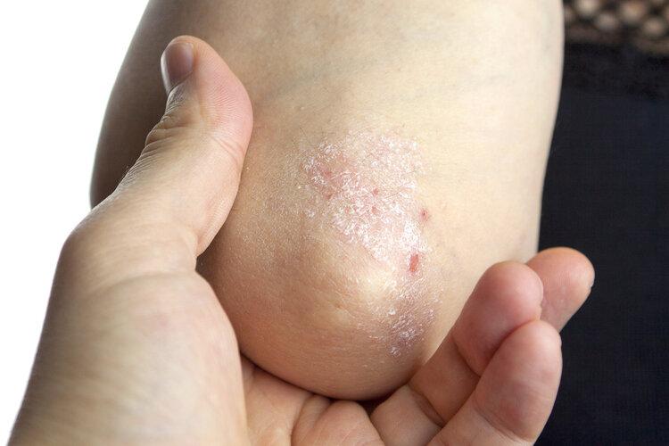 皮肤病诊断新利器，拍图识别在湿疹图片分析中的应用
