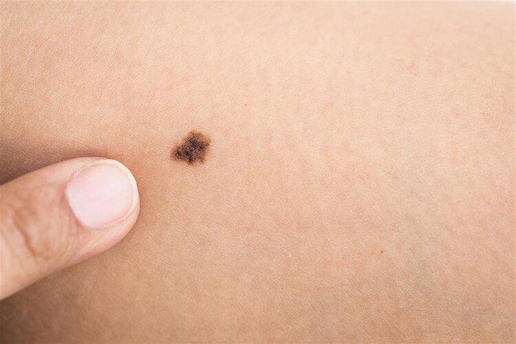 身体皮肤出现红色斑点，不痛不痒的背后真相