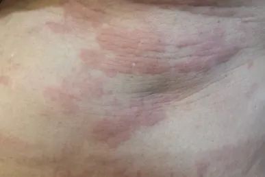 皮肤红色斑块，一扣即痒的背后真相与应对策略