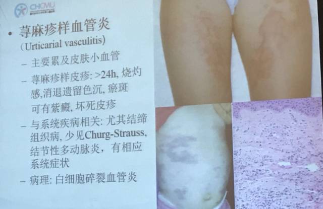 揭秘皮肤上的癣样小斑块，成因、诊断与应对策略