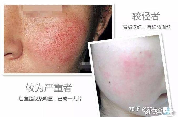 皮肤上红色的小血点，成因、担忧与应对策略