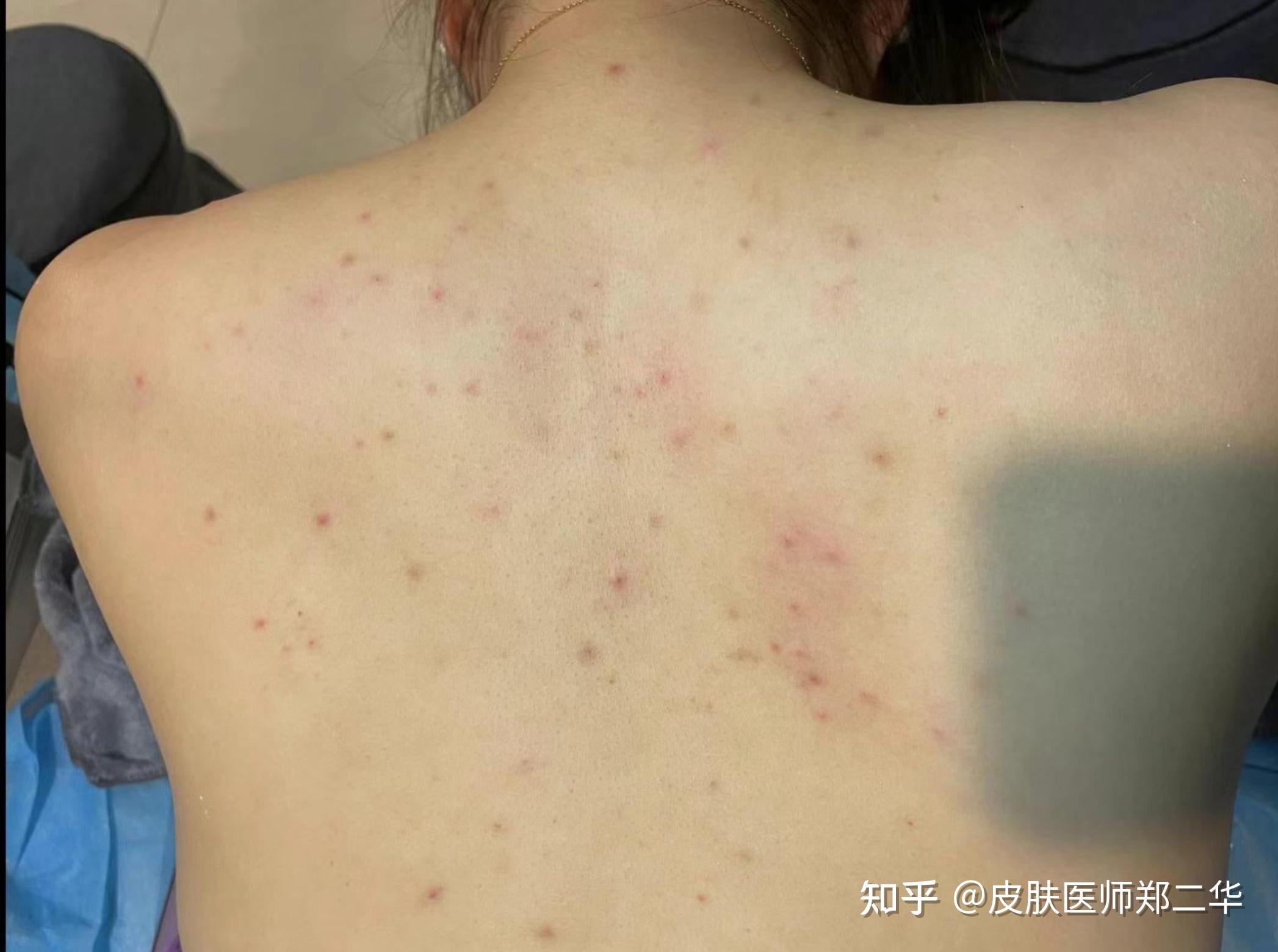 皮肤红色斑点伴瘙痒，了解症状、原因及治疗药物