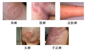 皮肤癣，认识症状，掌握有效治疗方法