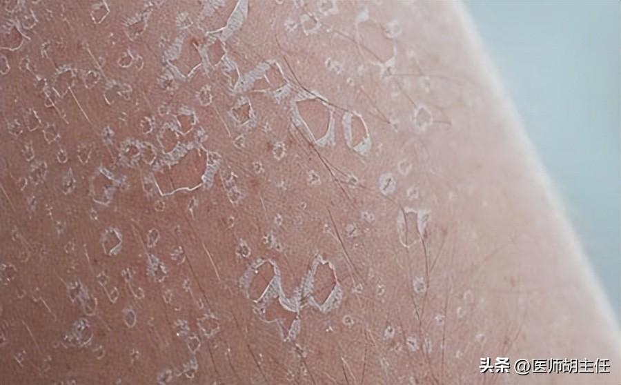 皮肤癣，从图片到症状的全面解析
