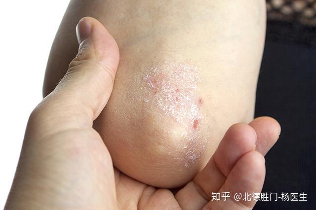 皮肤干燥起皮屑，寻找最有效的药膏解决方案