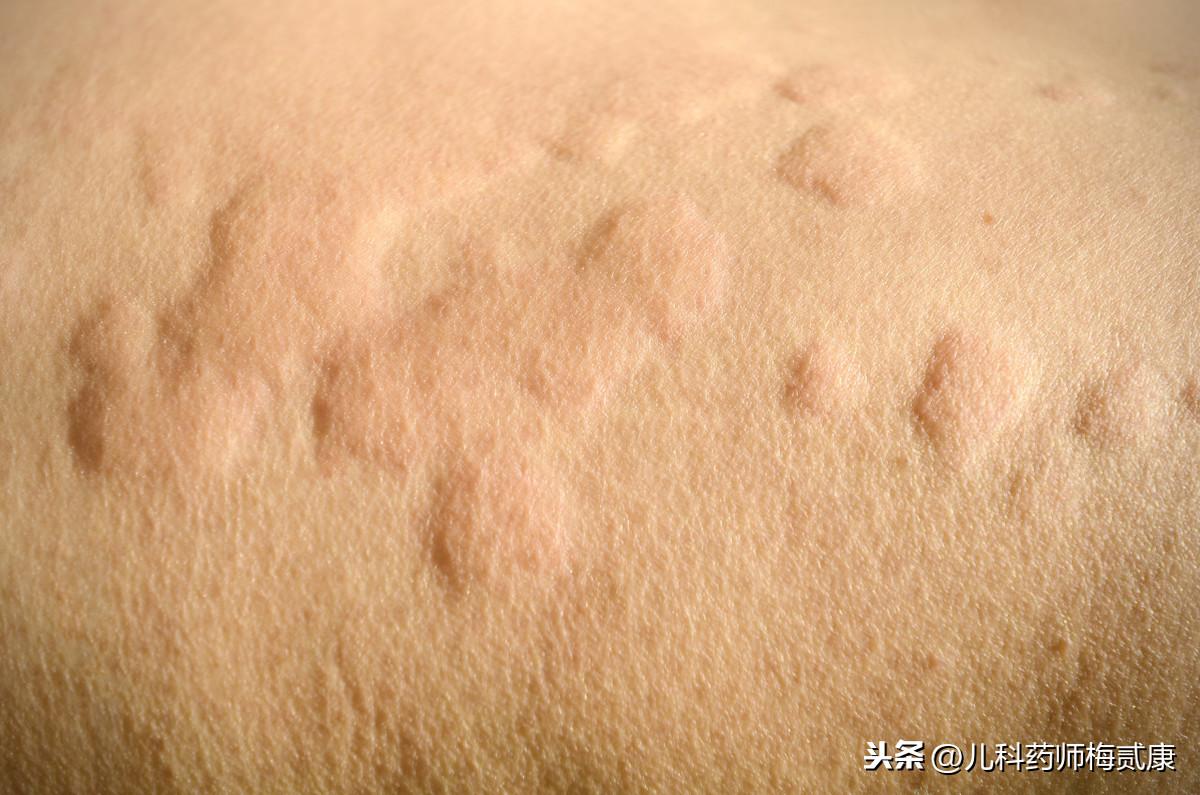 皮肤突然很痒一抓就起疙瘩，原因、应对与预防
