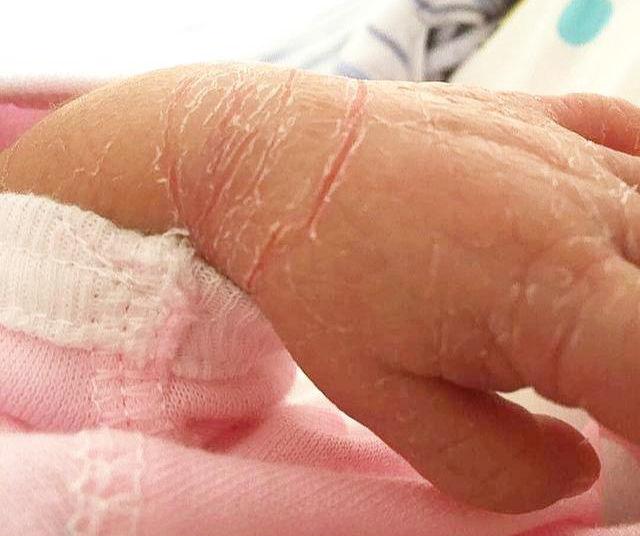 皮肤干燥脱皮起皮屑的恢复之道，从内而外的滋养与护理