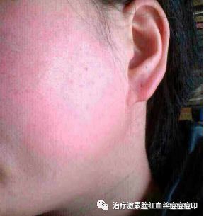 皮肤过敏，快速缓解与护理的全面指南