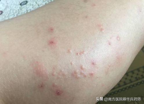 脸部皮肤过敏，痒的困扰与应对策略