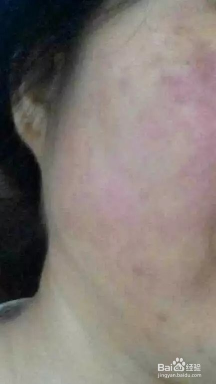 过敏皮肤大面积发红的应对策略