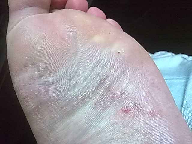 皮肤过敏红肿痒，探寻背后的原因与应对策略