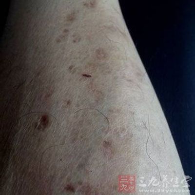 真菌性皮肤病——癣的全面解析