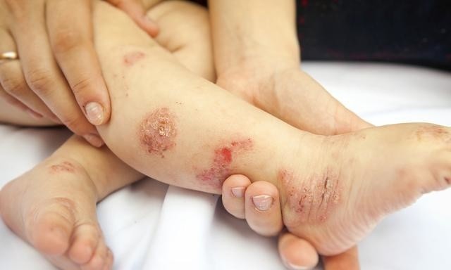 湿疹皮肤病，认识、症状与治疗