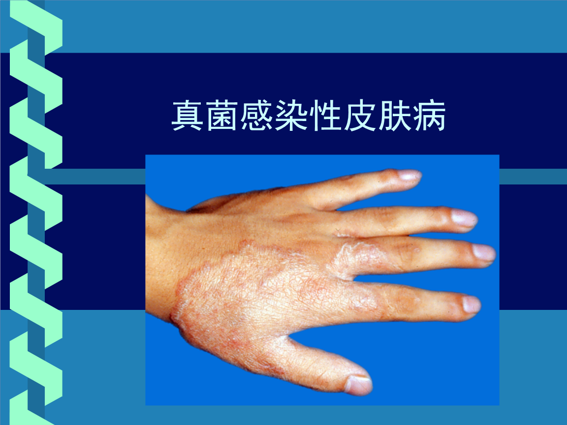 真菌引起的皮肤病，认识、症状与预防