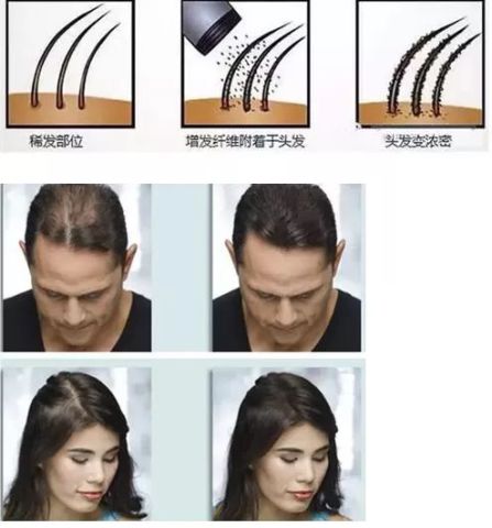 头发稀疏的青少年，自然与科学并重的增发策略