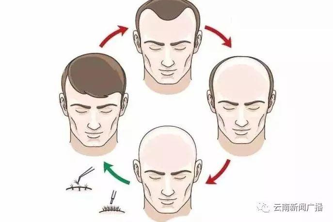 头发突然秃了一块，科学方法与心理调适并进，助力新发生长