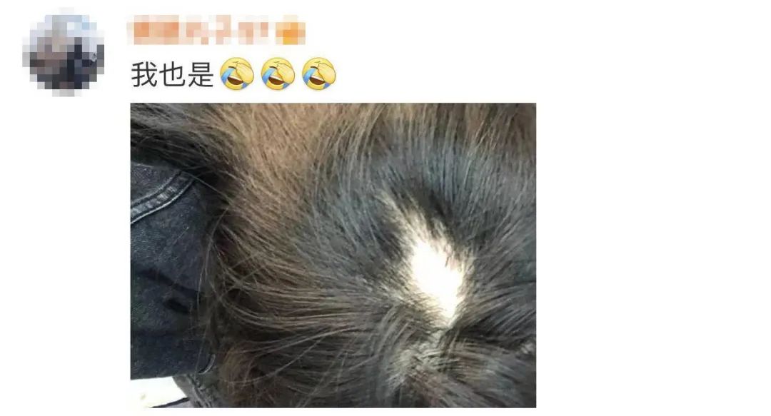 头发突然秃了一块，就医指南与科室选择