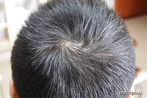 头发变白，科学调理，重焕黑亮