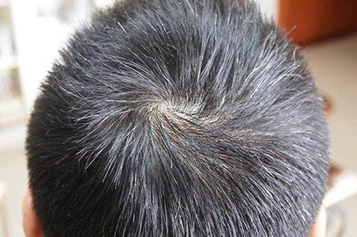 遗传性头发稀疏，重塑浓密秀发的科学探索