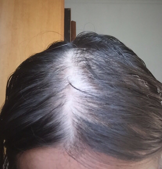 头发发叉，身体缺乏营养的信号灯