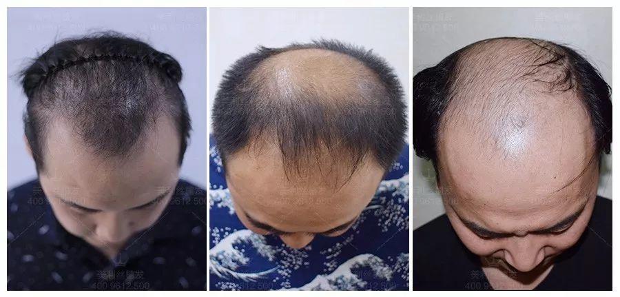 头发掉得很严重，原因解析与应对策略