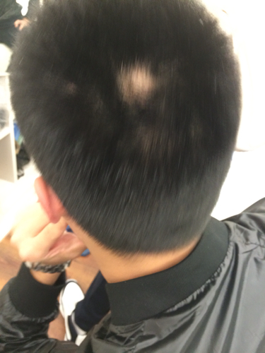 头发突然秃了一块，还能长出来吗？