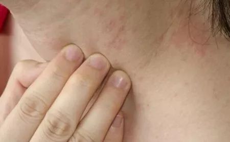 皮肤瘙痒与湿疹，寻找最佳药物治疗方案