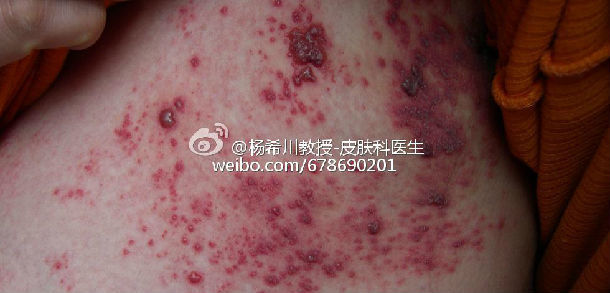 老年皮肤瘙痒的困扰与特效药探索