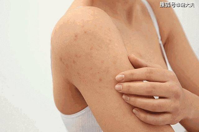 皮肤痒一挠就起小疙瘩，原因、应对与预防策略