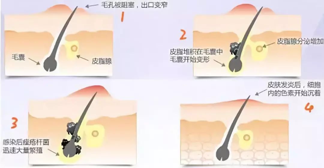 挠皮肤起疙瘩，探究背后的原因与应对策略
