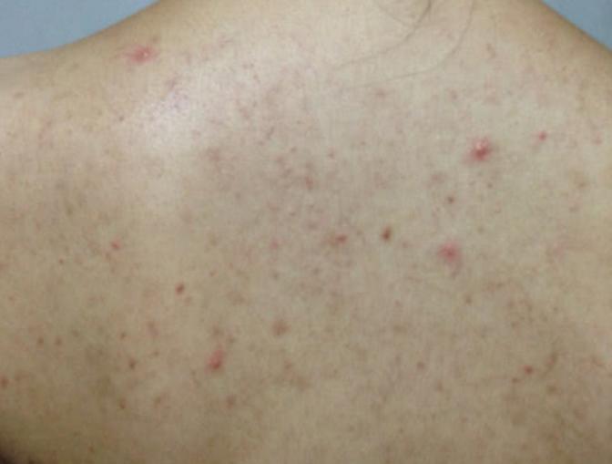 皮肤起小疙瘩很痒，原因、应对与预防策略