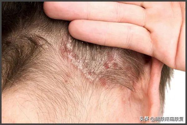 探索后背皮肤病的多样面貌，从症状到预防的全面解析