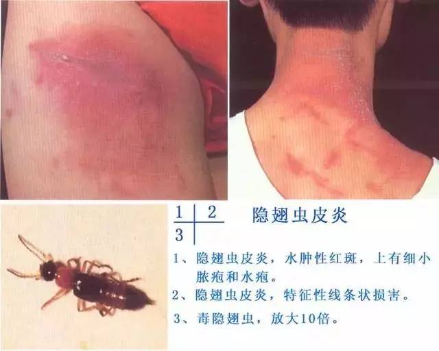 皮肤病血毒片的副作用，了解与应对
