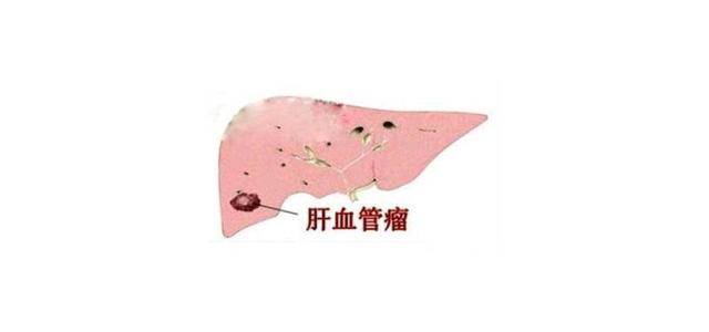 肝脏血管瘤，症状、危害与应对策略