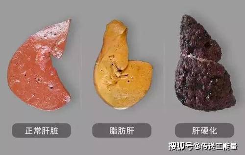 解读肝脏B超结果，从专业术语到日常健康指南