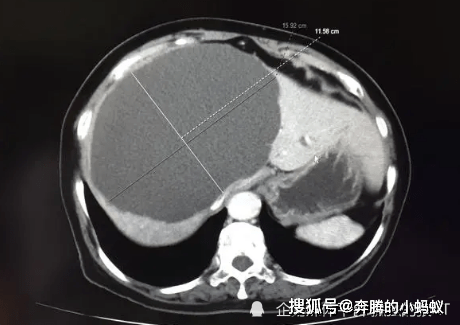 肝脏囊肿，了解其重要性及应对策略